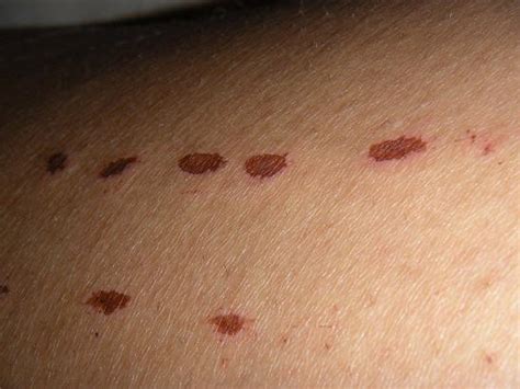 Unfortunately, hypopigmentation is a side effect of the hair removal treatment that can occur in up to 10% of people who have laser hair removal; Sona Med Spa Laser Hair Removal - Burns!! Review 193231 ...