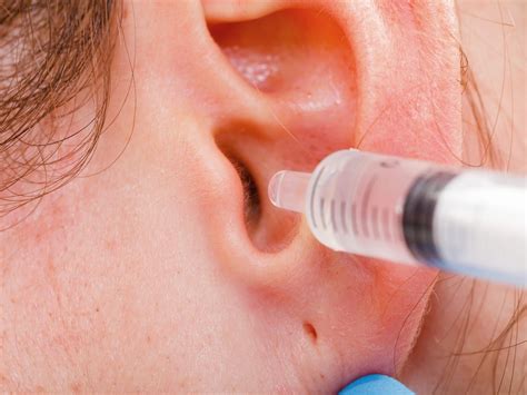 Cerumen Ear Wax Impaction Removal At Md First Primary And Urgent Care