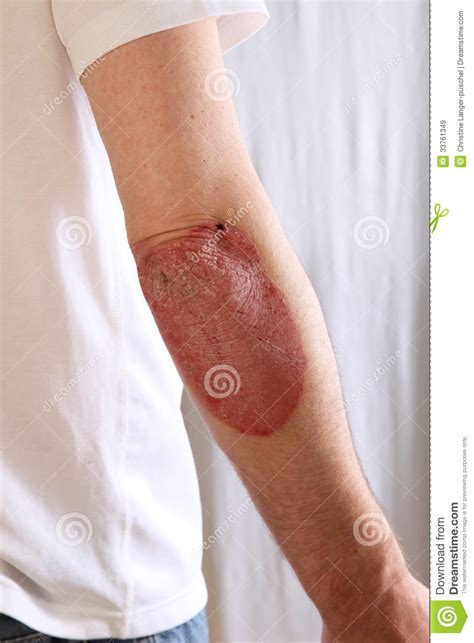Person Suffering From Psoriasis Stock Image Image Of Inflammatory
