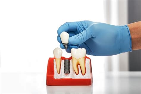 Dental Implants Long Term Tooth Replacement Solution Wright Dental