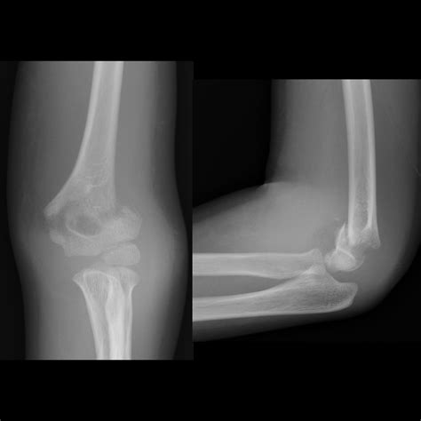 Pediatric Elbow Fracture Pediatric Radiology Reference Article