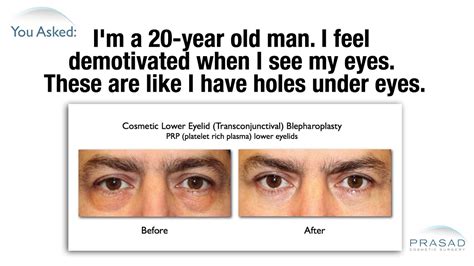 I don't really notice many young people with puffy eyebags but perhaps you are referring to a form of blepharoplasty that some seek out Why Puffy Eye Bags Can Happen at a Young Age, and Why ...
