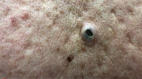 Dr Pimple Poppers Best And Worst Cases
