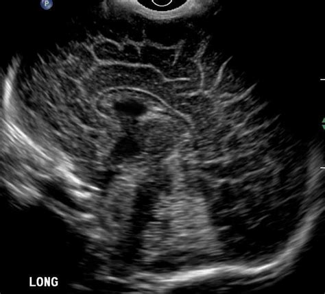 Normal Neonatal Head Ultrasound Neonatal Ultrasound Diagnostic