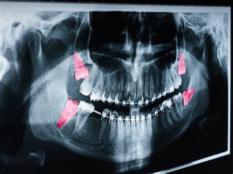 Growing Wisdom Teeth Pain On X Ray Stock Photo Image Of Diagnosis