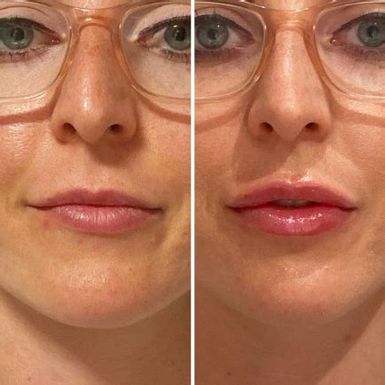 Juvederm Lips Before And After Syringe Lipstutorial Org