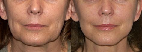Botox For Sagging Jowls Before And After