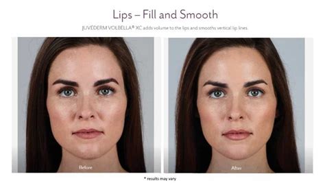 Lip Fillers With Juv Derm