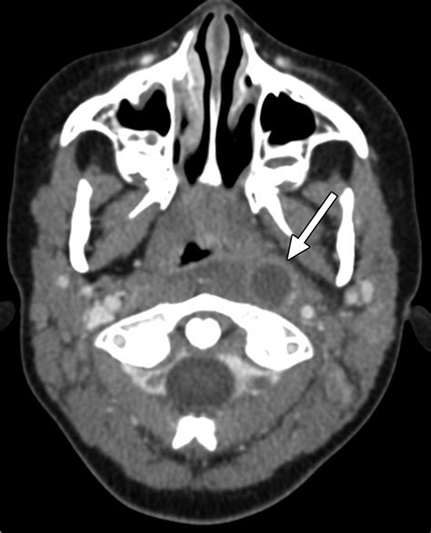 Imaging Of Cervical Lymphadenopathy In Children And Young Adults Ajr