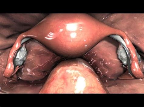 Pelvic Anatomy Laparoscopy Laparoscopic Hysterectomy Carcinoma