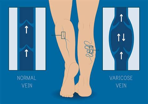 Understanding Chronic Venous Insufficiency Here At The Alpha Vein Clinic
