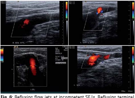 Duplex Ultrasound In The Assessment Of Lower Extremity Venous