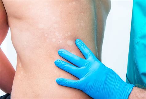 What Causes White Spots On Skin And How To Treat Them