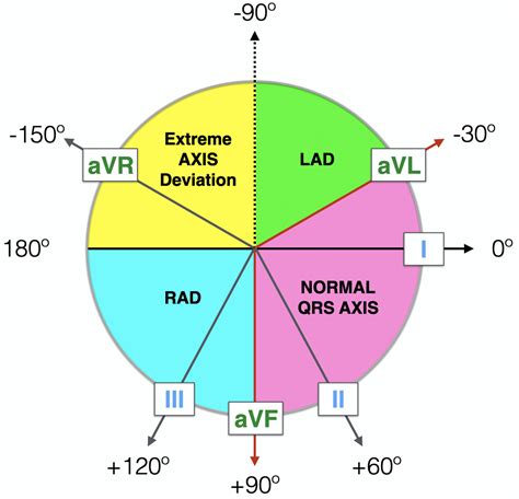Right Axis Deviation Rad Litfl Ecg Library Diagnosis