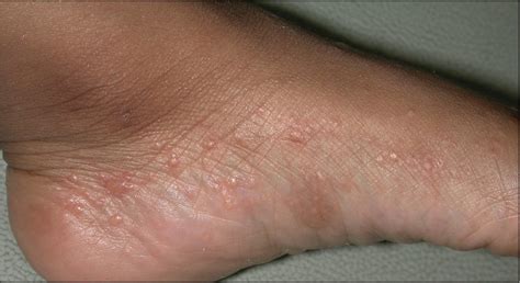 Dyshidrotic Eczema On Bottom Of Feet