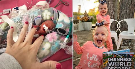 ‘worlds Most Premature Twins Celebrate Their 2nd Birthday After Beating The Odds