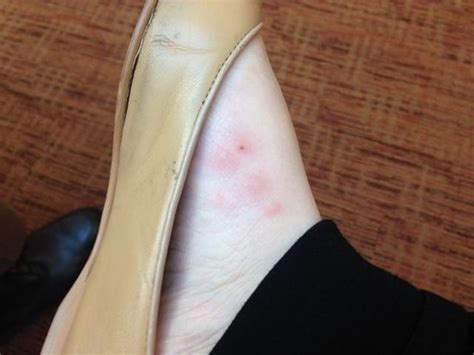 Bug Bites On My Foot That Appeared Over Night Picture Of Holiday Inn