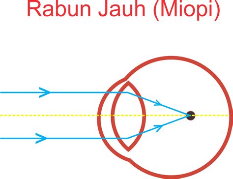 Cahaya Dan Alat Optik Cacat Mata Miopi Hipermetropi Presbiopi