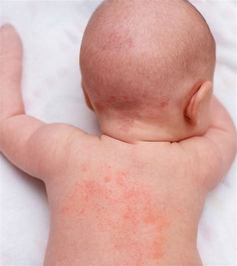 Baby Heat Rash What Is It Causes And How To Prevent It