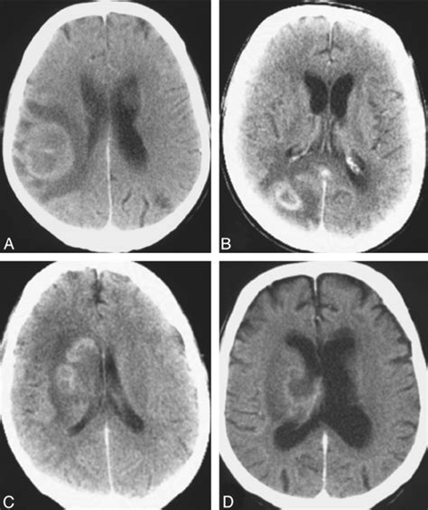 Contrast Enhancing Lesions On Ct Scans Ad In 4 Patients With