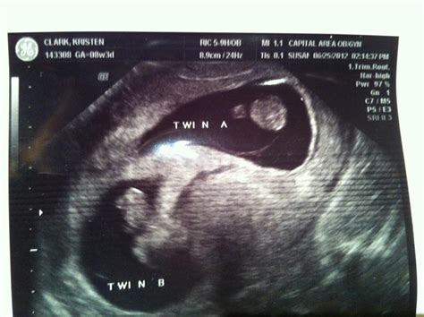 Beauty In The Breakdown The 7 Stages Of Pregnancy With Twins Stages 1 3