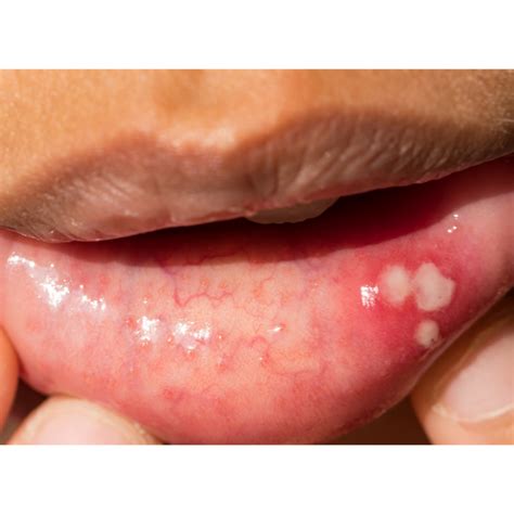 Canker Sores What They Are And How To Manage Them Sentinel Mouthguards
