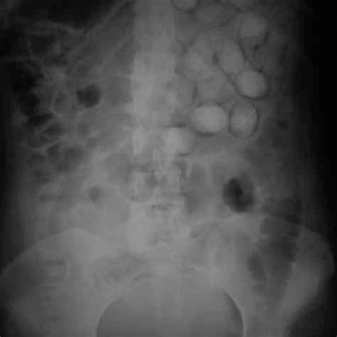 Pelvic X Ray Demonstrates Multiple Radiopaque Foreign Bodies