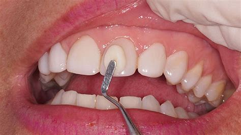 ¿qué Es Una Resina Dental Perudentus Clinica Dental En Huaraz