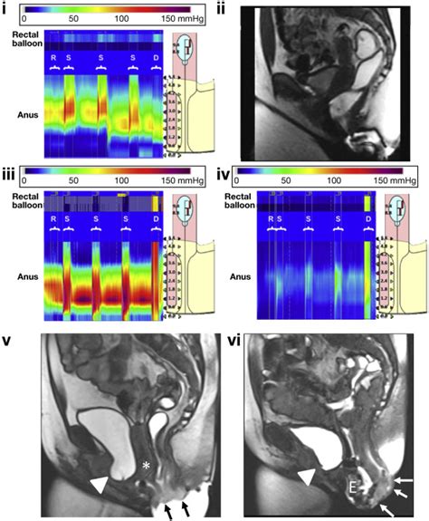 High Resolution Anorectal Manometry For Identifying Defecatory