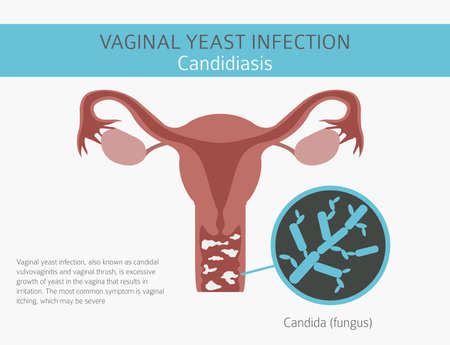 Vector Of Vaginal Yeast Infection Id Royalty Free Image