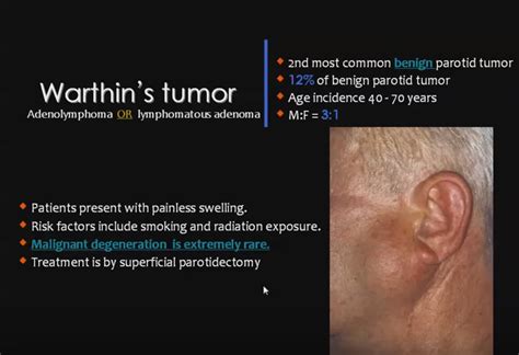 Warthins Tumor Tumor Salivary Gland Radiation