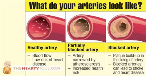 Warning Signs Your Arteries Are Dangerously Clogged And Narrowing