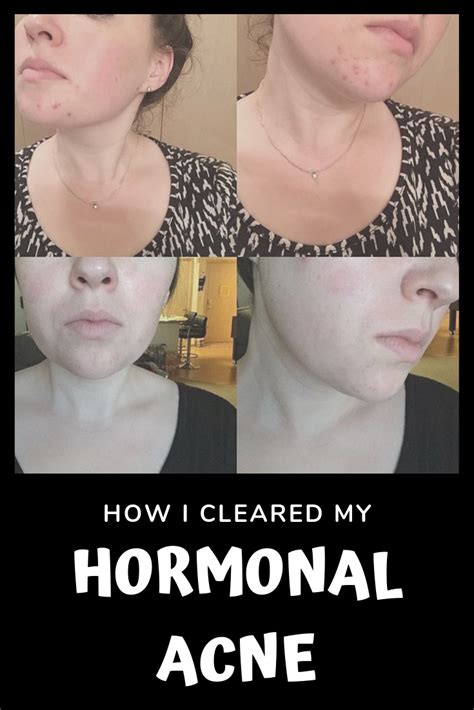 Acne Cleared Hormonal From 2014 2017 I Tried Everything I Saw