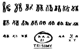 Therefore, there are three copies of some portions of the chromosome, and two copies of the remaining portions. Trisomy 21 syndrome. Causes, symptoms, treatment Trisomy ...