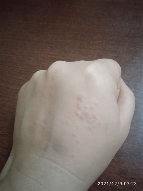 Сыпь на кистях рук и сильный зуд не проходит Вопрос дерматологу 03