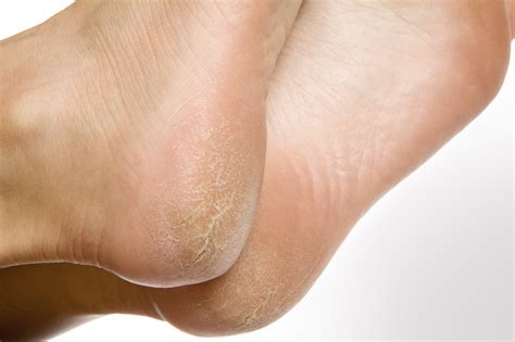 Treatment And Prevention For Cracked Dry Heels Heel Fissure Footfiles