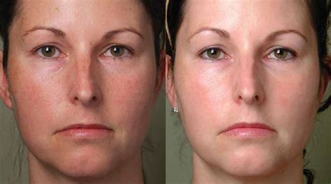 before and after ipl photofacial cosmetic surgery ipl photofacial rhinoplasty
