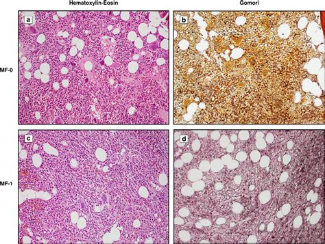 Examples Of Morphological Features Of Primary Myelofibrosis And The