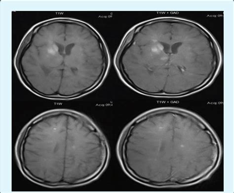 Third Mri More Plaques In Periventricular And Subcortical White
