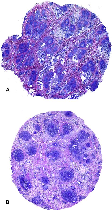 Histologic Features Of Chronic Cutaneous Lupus Erythematosus Of The