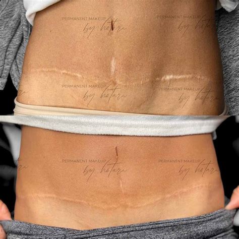 Details 74 Medical Tattoos For Scars Super Hot Ineteachers