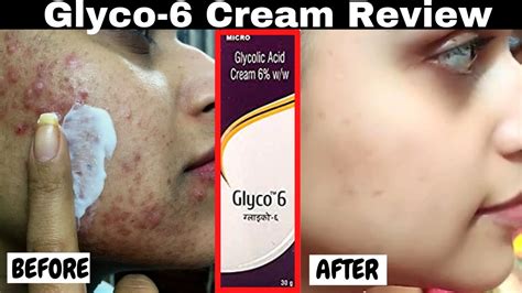 Glyco 6 Cream Glycolic Acid Remove Pigmentation Acne Scars