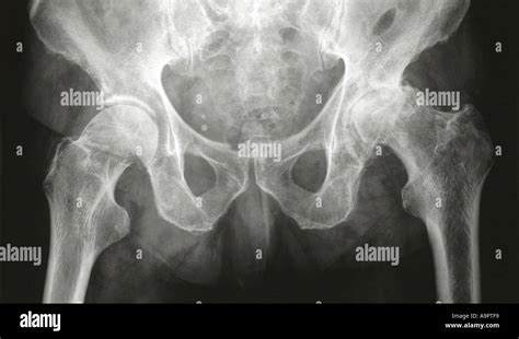 X Ray Osteoarthritis Of The Hip Joint Stock Photo Alamy