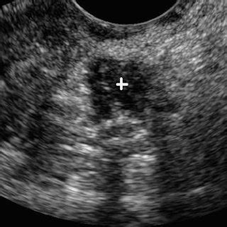 Shows Sagittal Transvaginal Ultrasound Scan View Of A Uterus During The Images