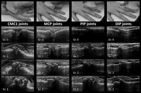 Ultrasonographic Assessment Of Osteophytes In 127 Patients With Hand