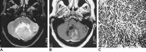 Case 1 33 Year Old Woman With Double Vision And Occipital Headaches