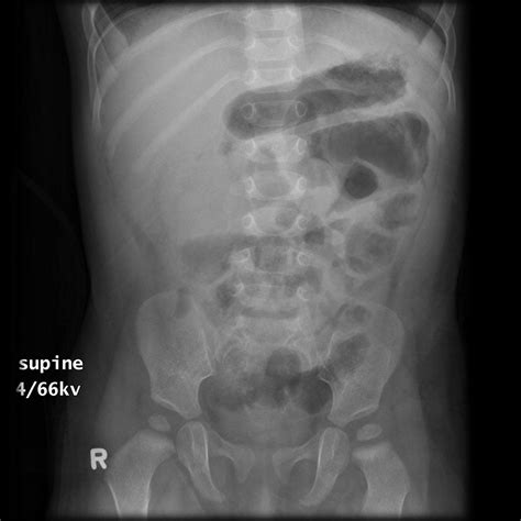 The Abdominal Xray A Relic Or A Reliable Tool — Taming The Sru