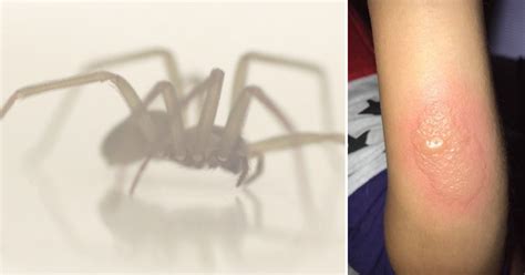 Apparent Brown Recluse Spider Bite Causes Alarming Infection