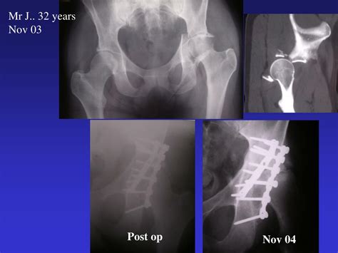Ppt Results Of Total Hip Arthroplasty After Acetabular Fractures My Xxx Hot Girl