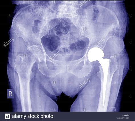 Osteoporosis Bone Scan Stock Photos And Osteoporosis Bone Scan Stock